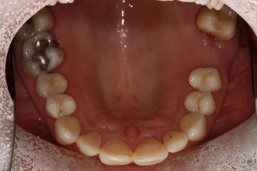 Invisalign straightening after