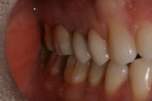 Porcelain crowns after