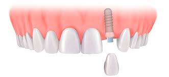 Single Implant and Crown