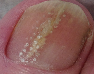 Clearanail for Fungal Nail Infections